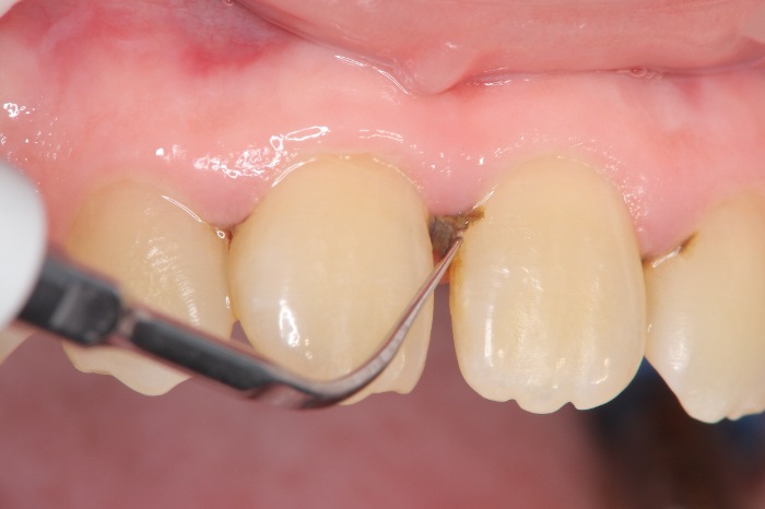 固く付着しており、歯茎に覆われているため取り除くことが難しい縁下歯石をスケーラーで取り除く"