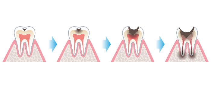 歯の根の部分の虫歯の進行が早い