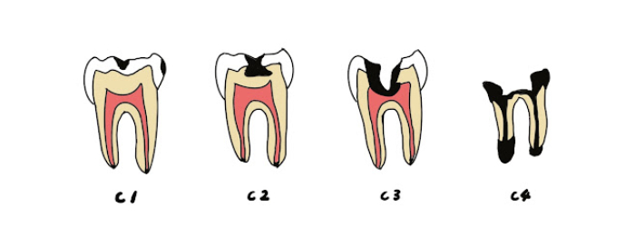 虫歯の見分け方を症状（分類）別にご紹介