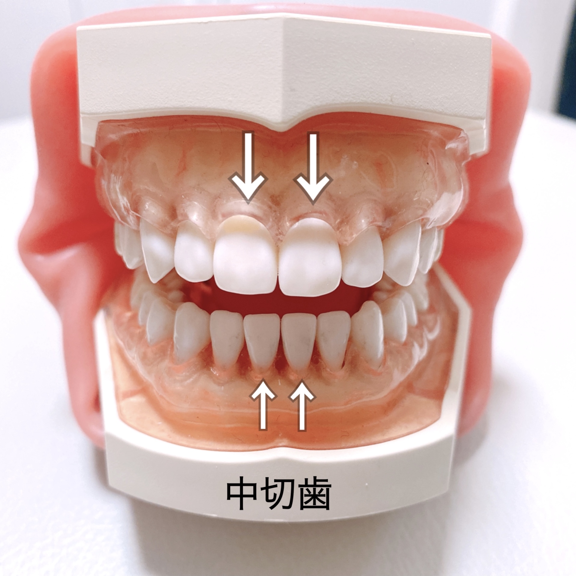 中切歯