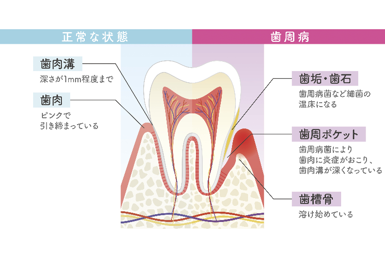 歯周病と関わりがある常在菌