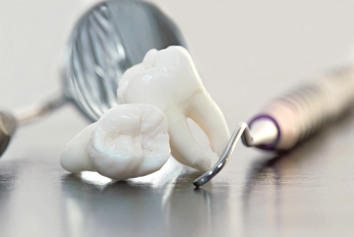 歯周病が進行し、歯を支えている歯槽骨が溶けると歯を残すことが難しくなる"