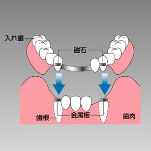 自分の歯の根を利用できない場合は磁性アタッチメントは取り付けられない"