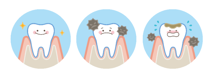 虫歯を放置しているとどうなる？