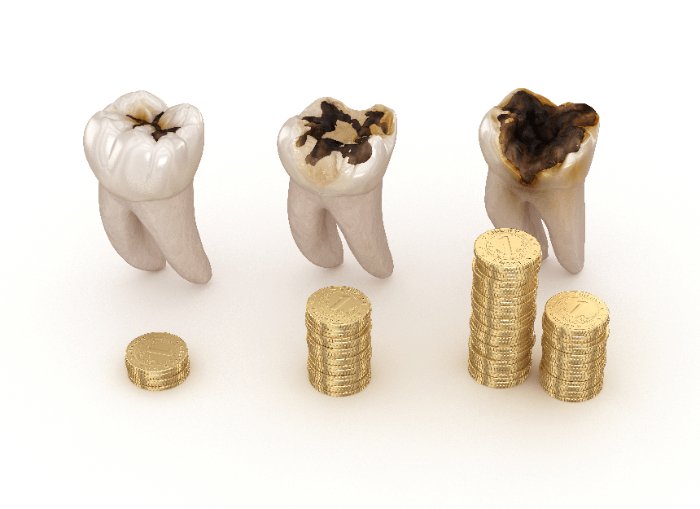 ボロボロの歯の治療費は高くなる？