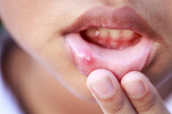 噛みタバコの習慣がある東南アジアでは頬粘膜がんの罹患率が非常に高い傾向にある"